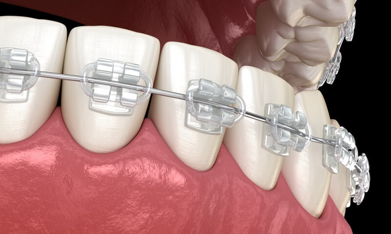 có nên tẩy trắng răng trước khi niềng răng