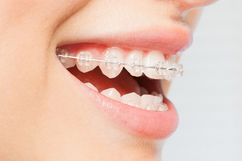 có nên tẩy trắng răng trước khi niềng răng