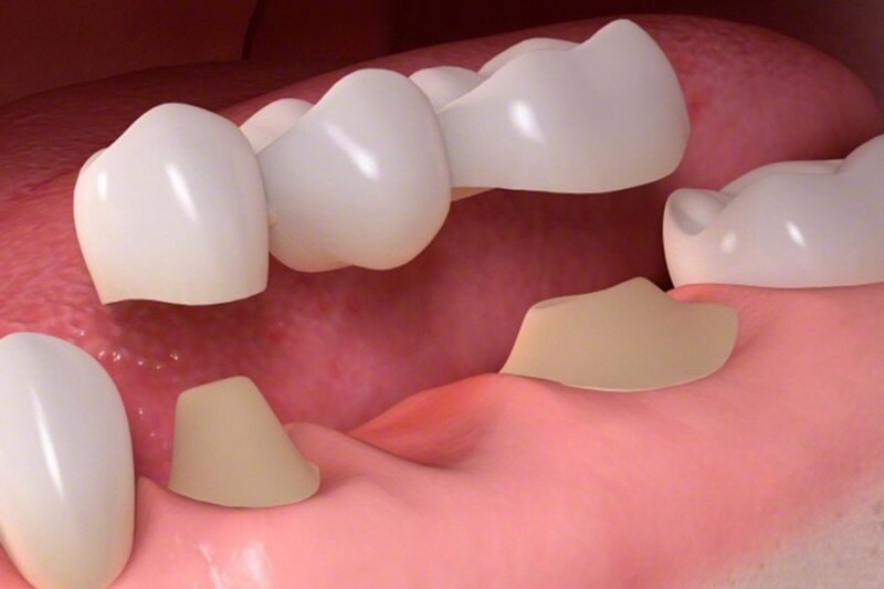 nên bọc răng sứ loại nào