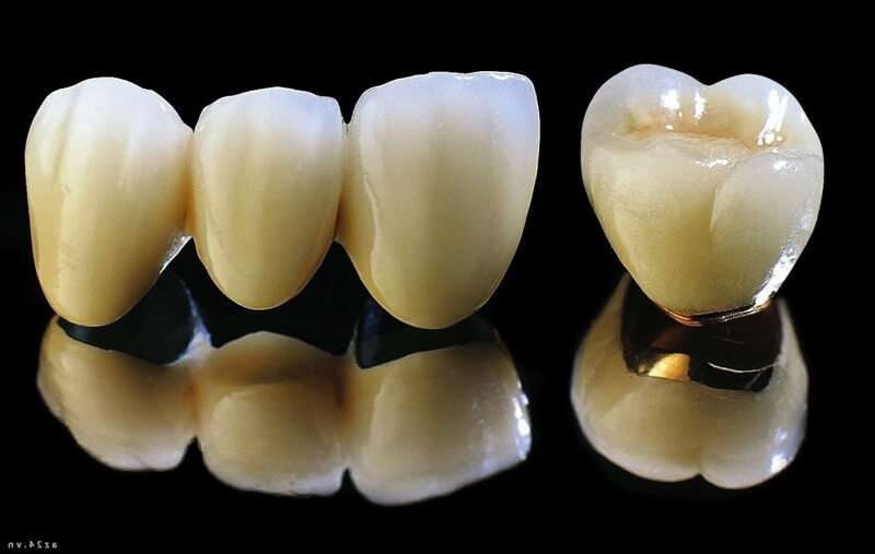 nên bọc răng sứ loại nào