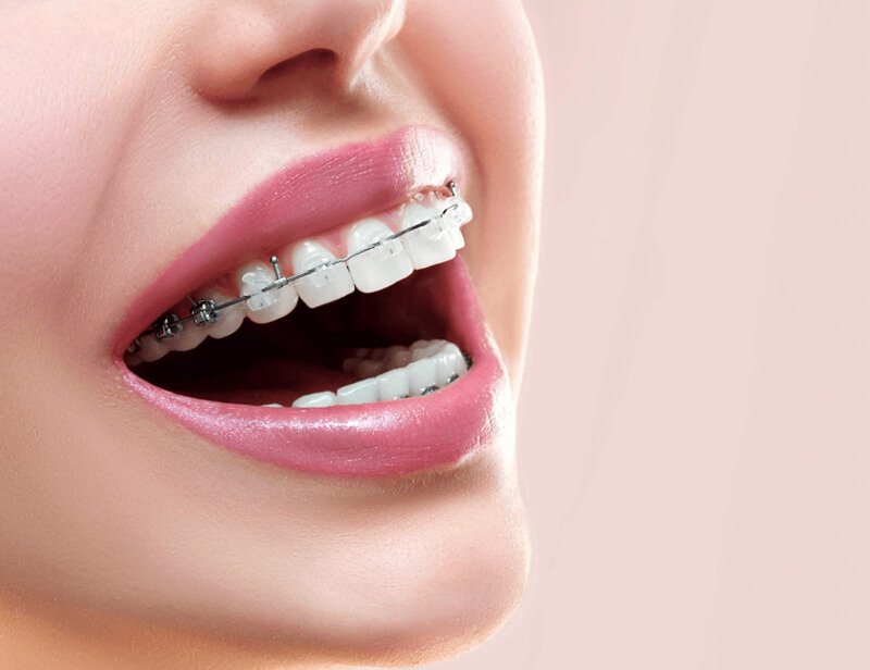 niềng răng cửa hô