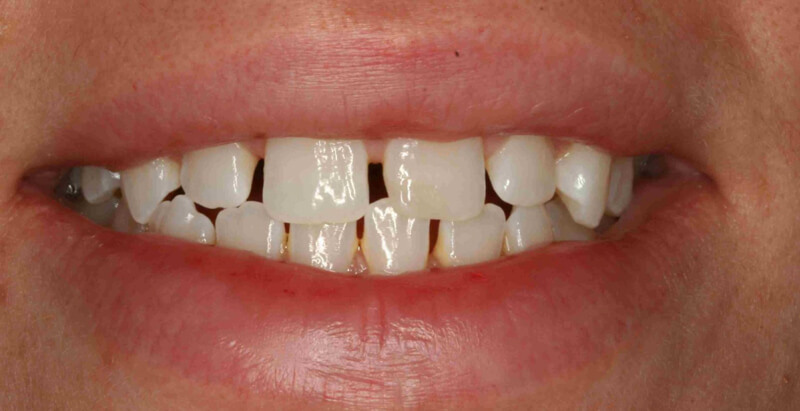 niềng răng cửa thưa