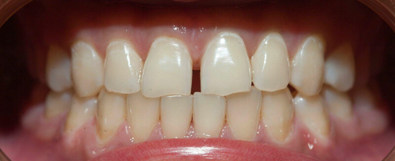 niềng răng cửa thưa