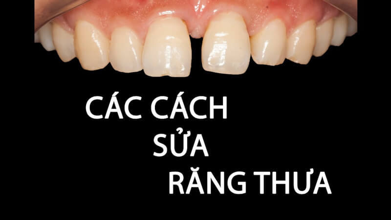 niềng răng cửa thưa mất bao nhiêu tiền