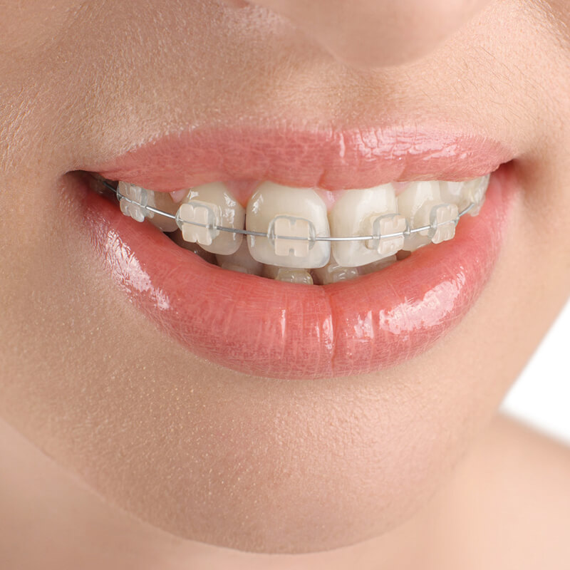 niềng răng hô hàm trên bao nhiêu tiền