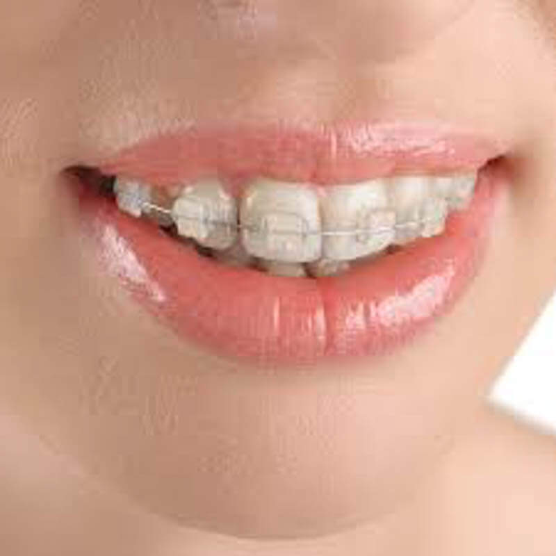 niềng răng hô hàm trên giá bao nhiêu