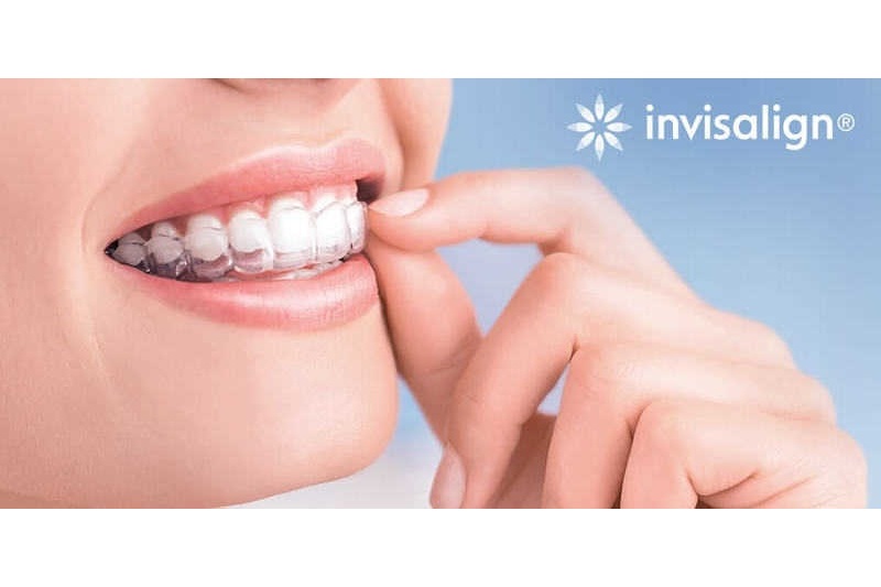 niềng răng invisalign