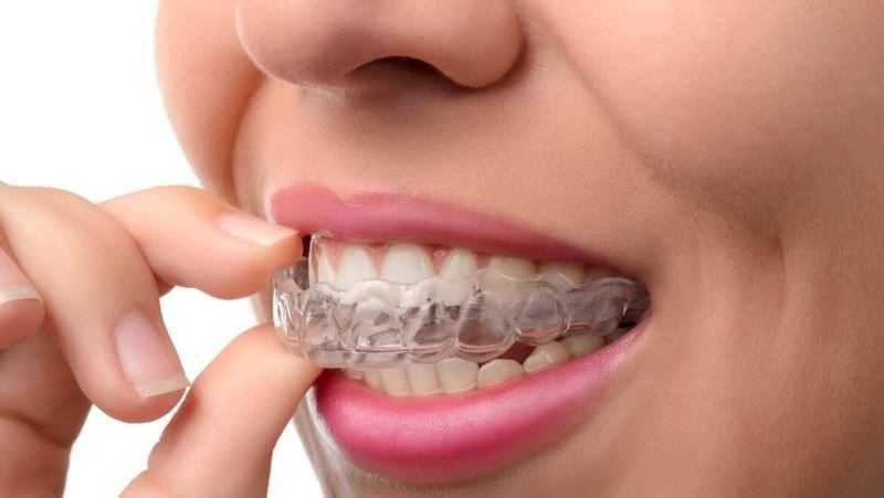 niềng răng invisalign