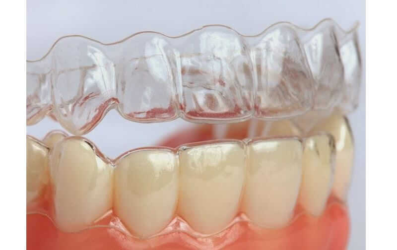 niềng răng invisalign ở đâu tốt