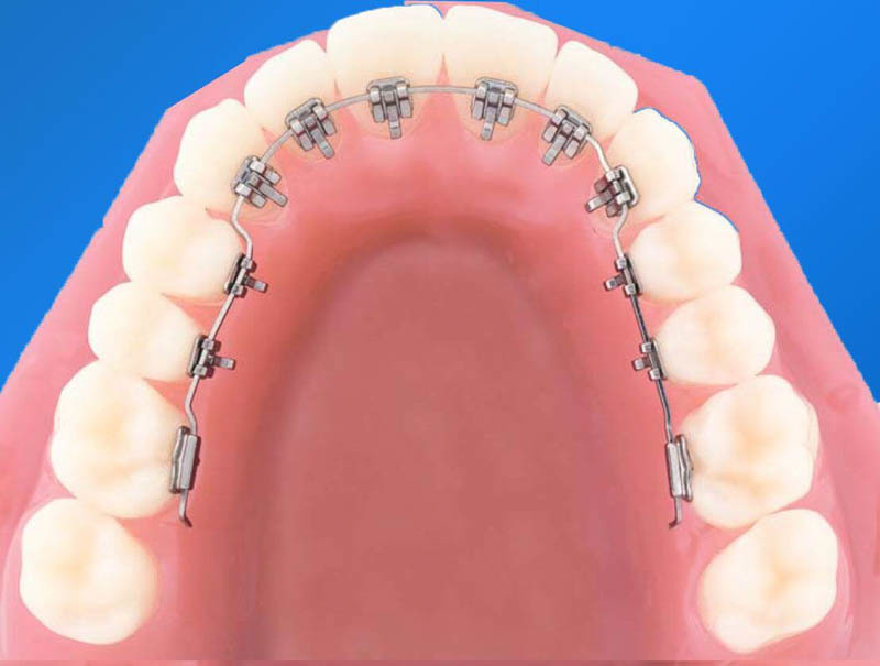 niềng răng mặt trong