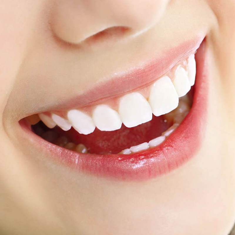 niềng răng nên hay không