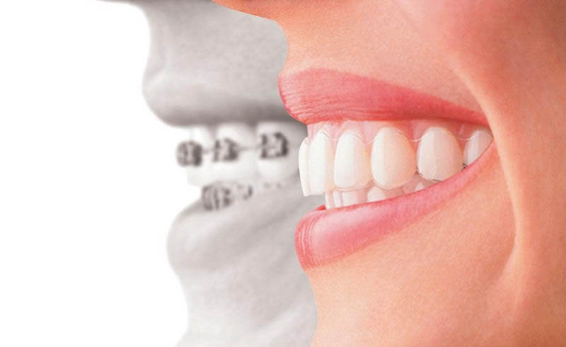 niềng răng thẩm mỹ