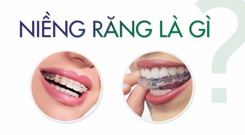 niềng răng thẩm mỹ