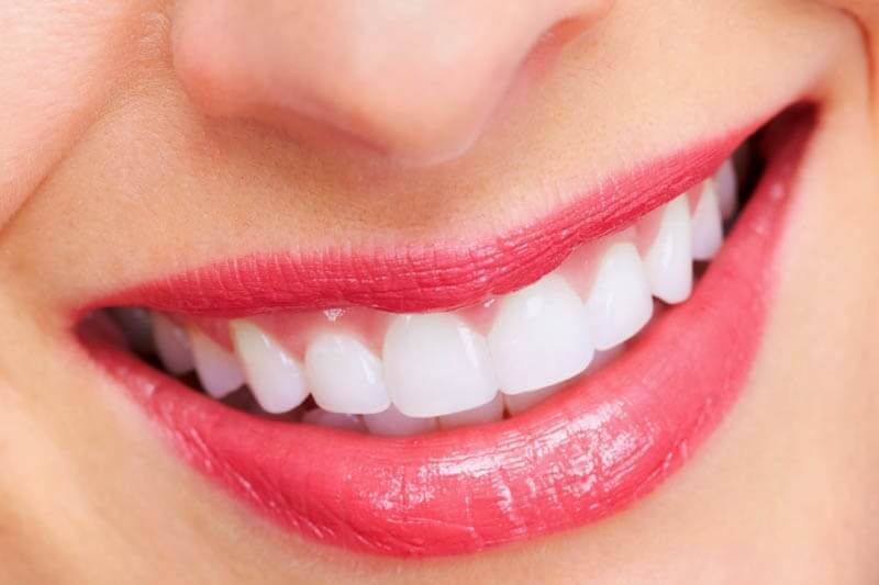 niềng răng thẩm mỹ