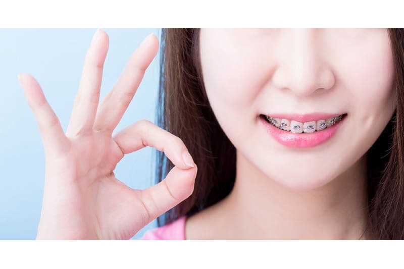 niềng răng tuổi 30