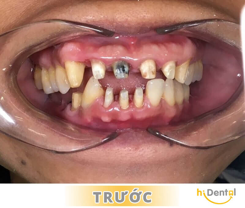 phục hình sứ - kim loại và phục hình toàn sứ