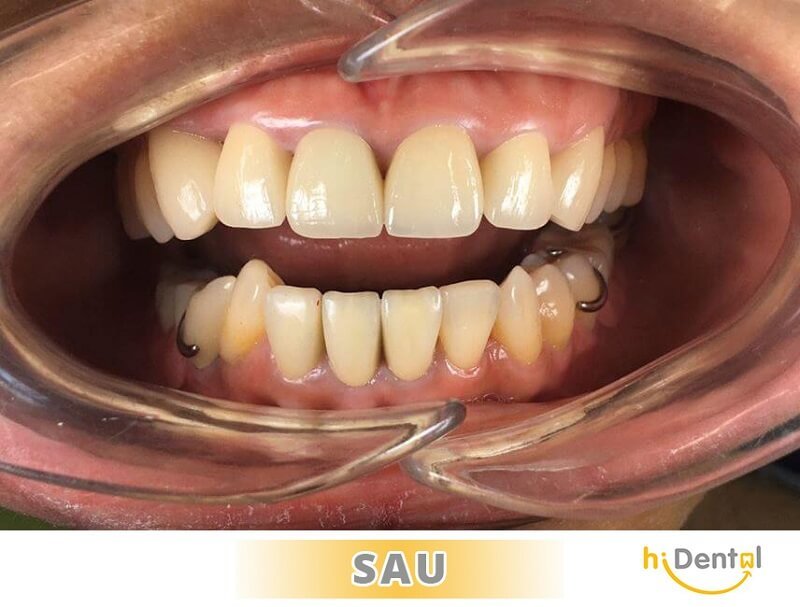 phục hình sứ - kim loại và phục hình toàn sứ