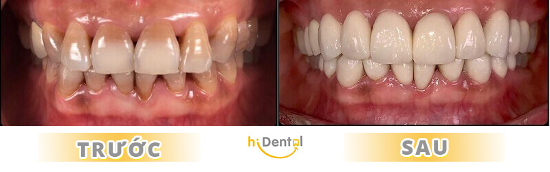 phục hình sứ - kim loại và phục hình toàn sứ