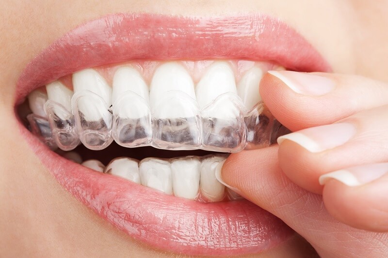 phương pháp tẩy trắng răng