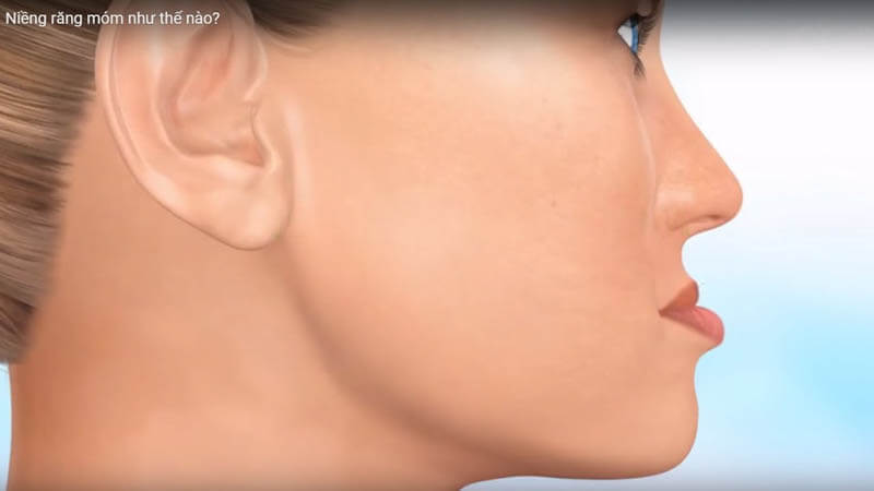 quá trình niềng răng móm