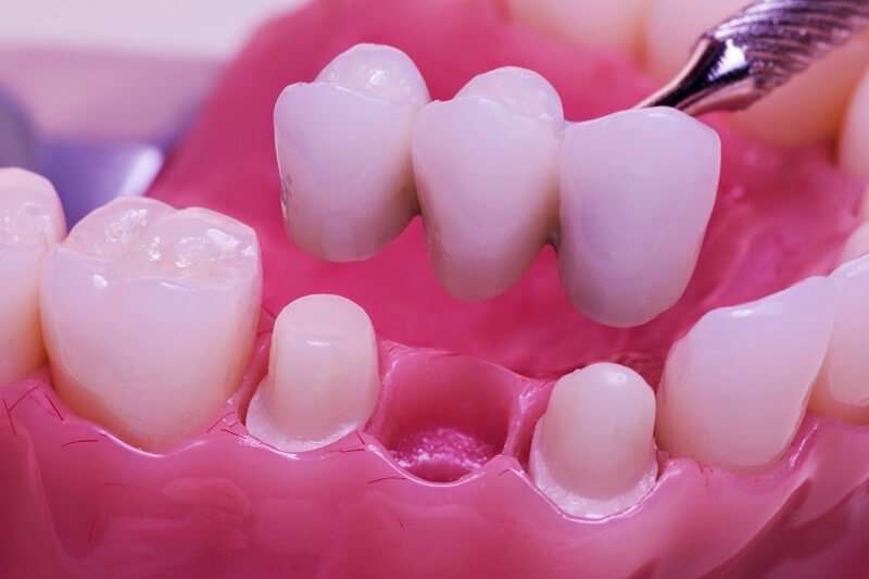 Quy trình bọc răng