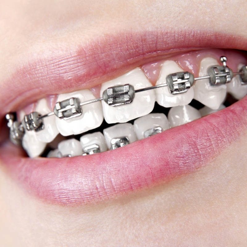 quy trình niềng răng hô