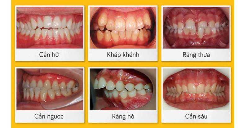 tác dụng của niềng răng