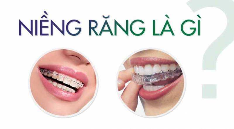 tại sao phải niềng răng