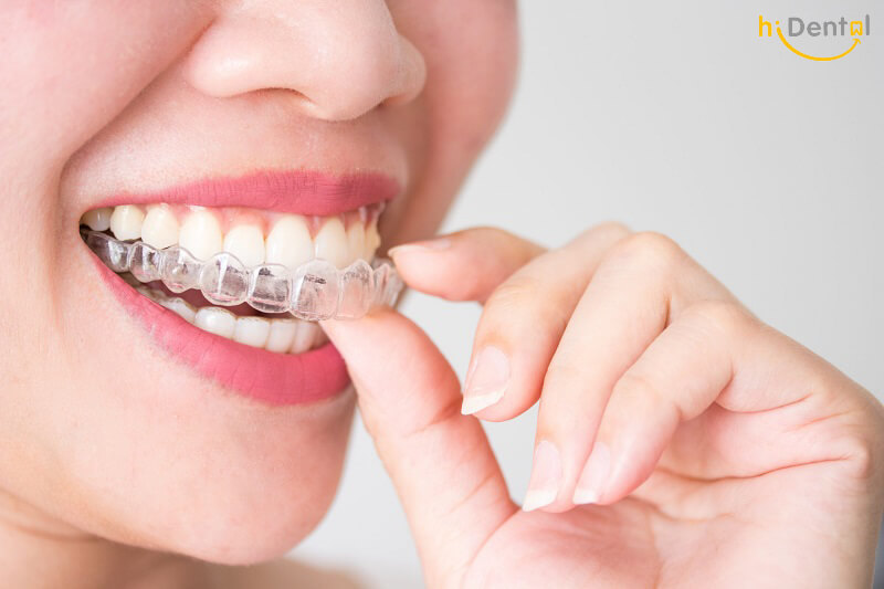 Tẩy trắng răng được bao lâu