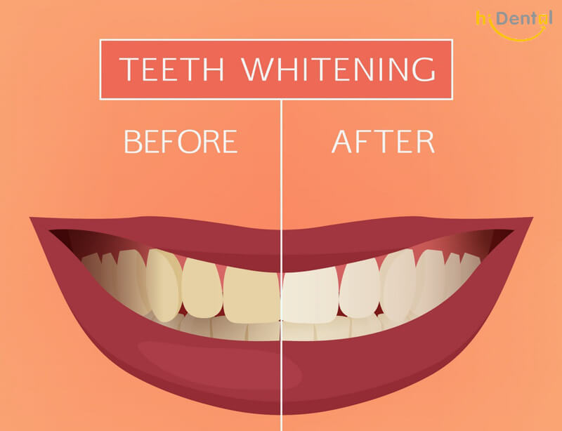 Tẩy trắng răng có ảnh hưởng gì không