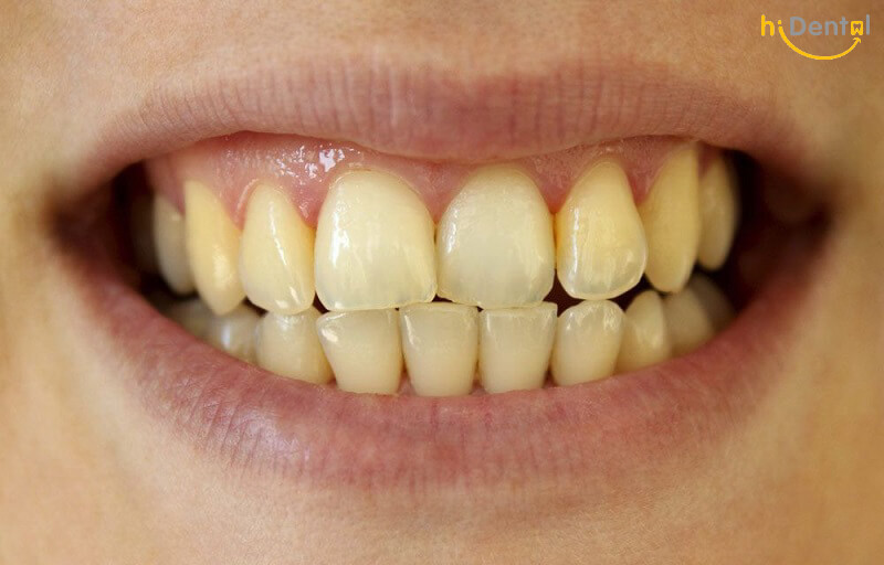 tẩy trắng răng có được uống bia không