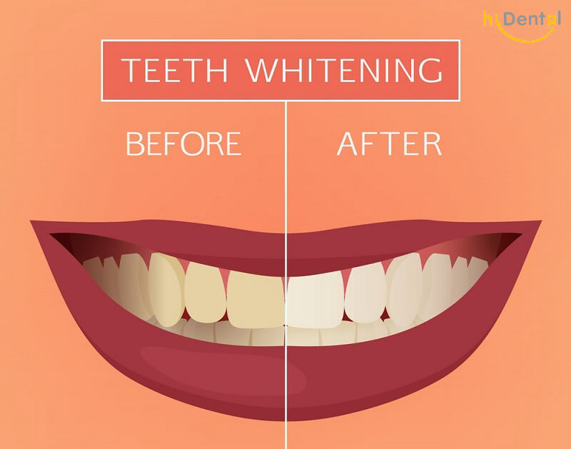 Tẩy trắng răng có mấy loại