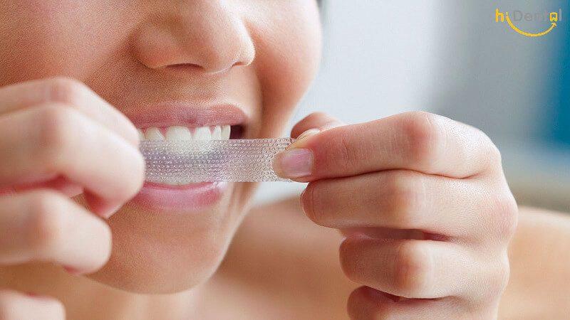 Tẩy trắng răng có mấy loại