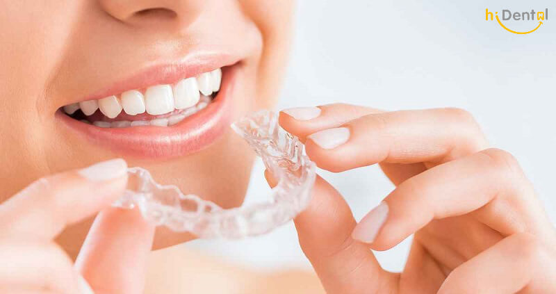 Tẩy trắng răng có mấy loại