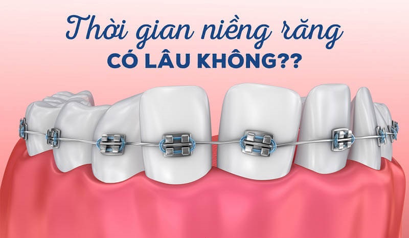 Thời gian niềng răng