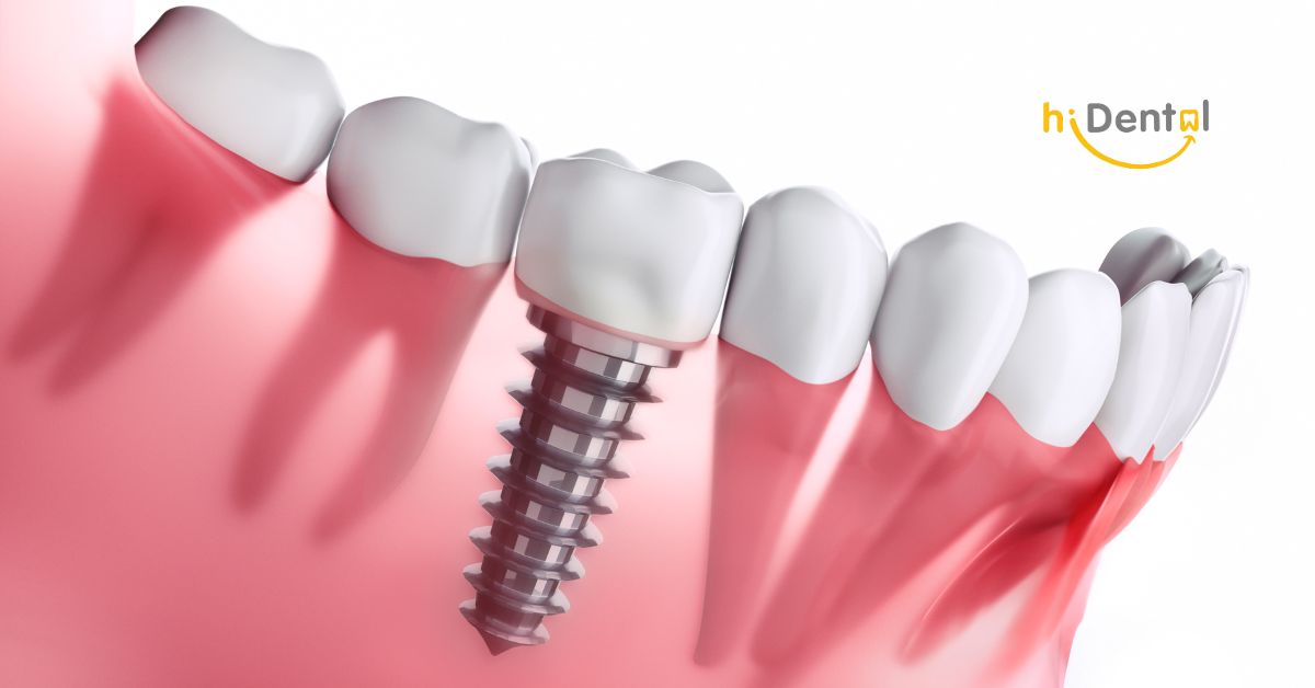 Trồng Răng Uy Tín HCM