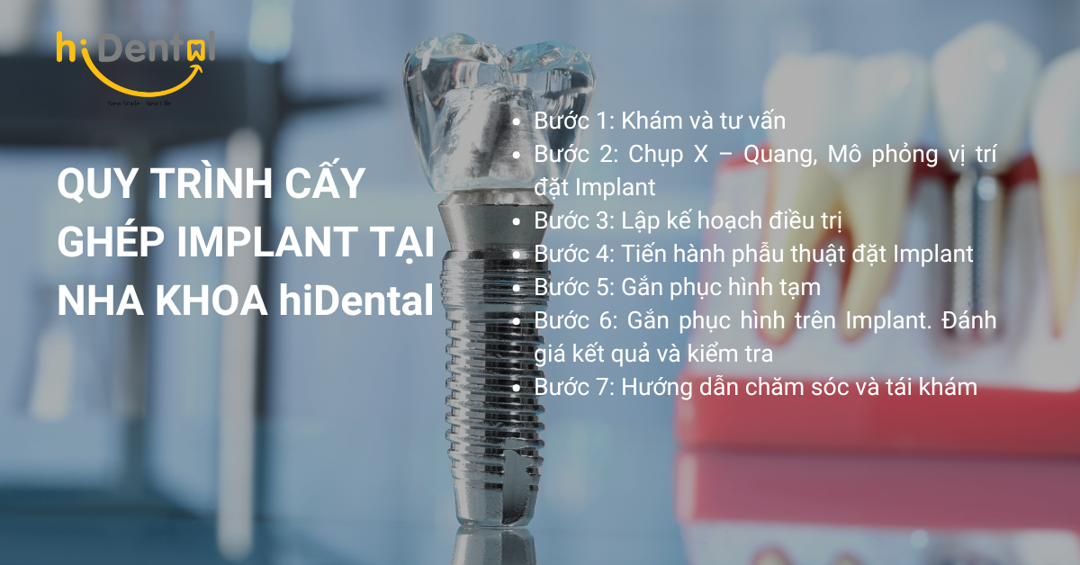 Quy Trình Cấy Ghép Implant hiDental