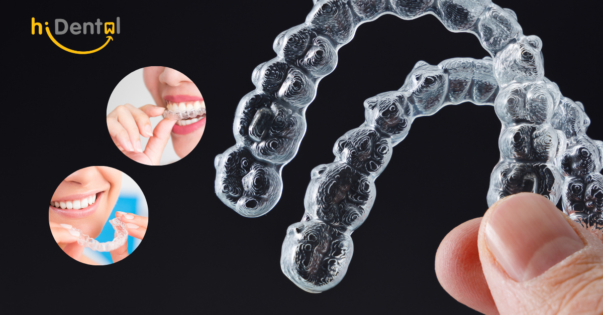 Quy Trình Niềng Răng Trong Suốt Clearcorrect