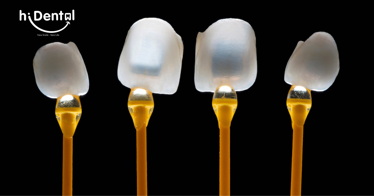 Mặt Dán Sứ Veneer