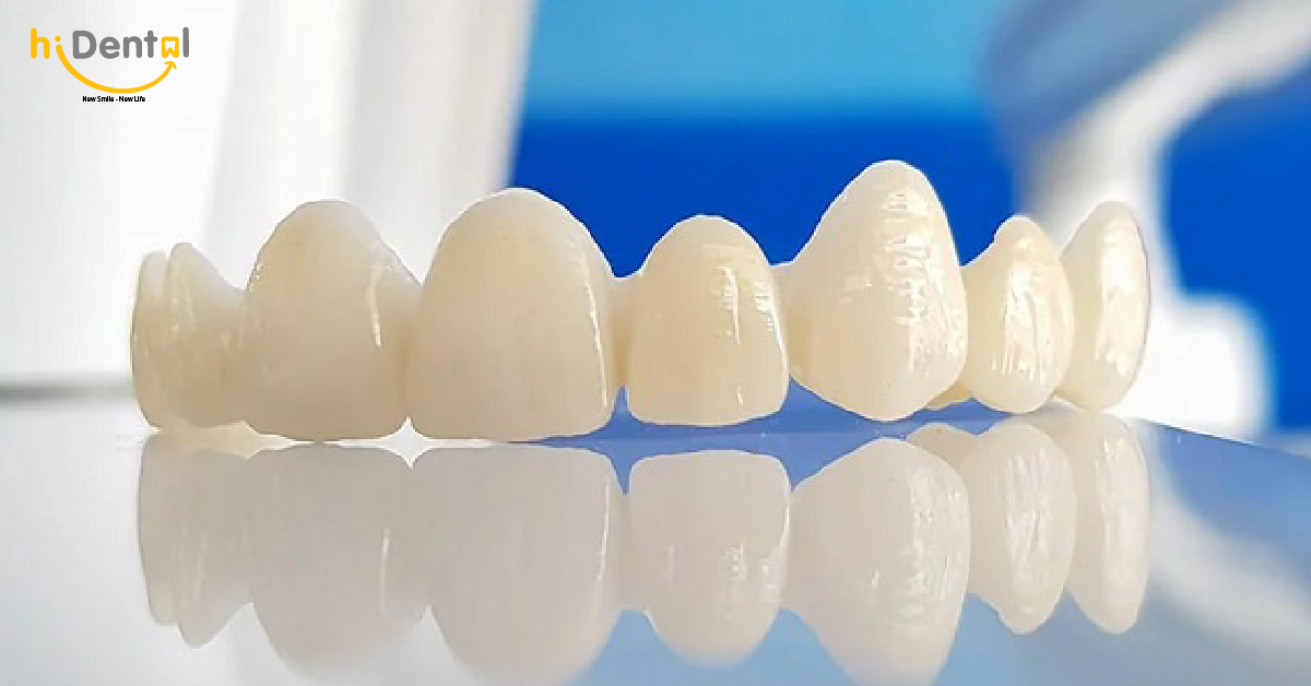 Răng Toàn Sứ Và Răng Sứ Kim Loại