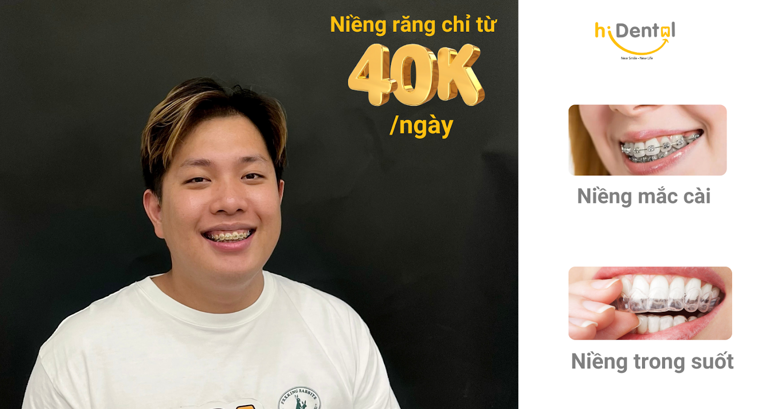 Chi Phí Niềng Răng Tại TPHCM