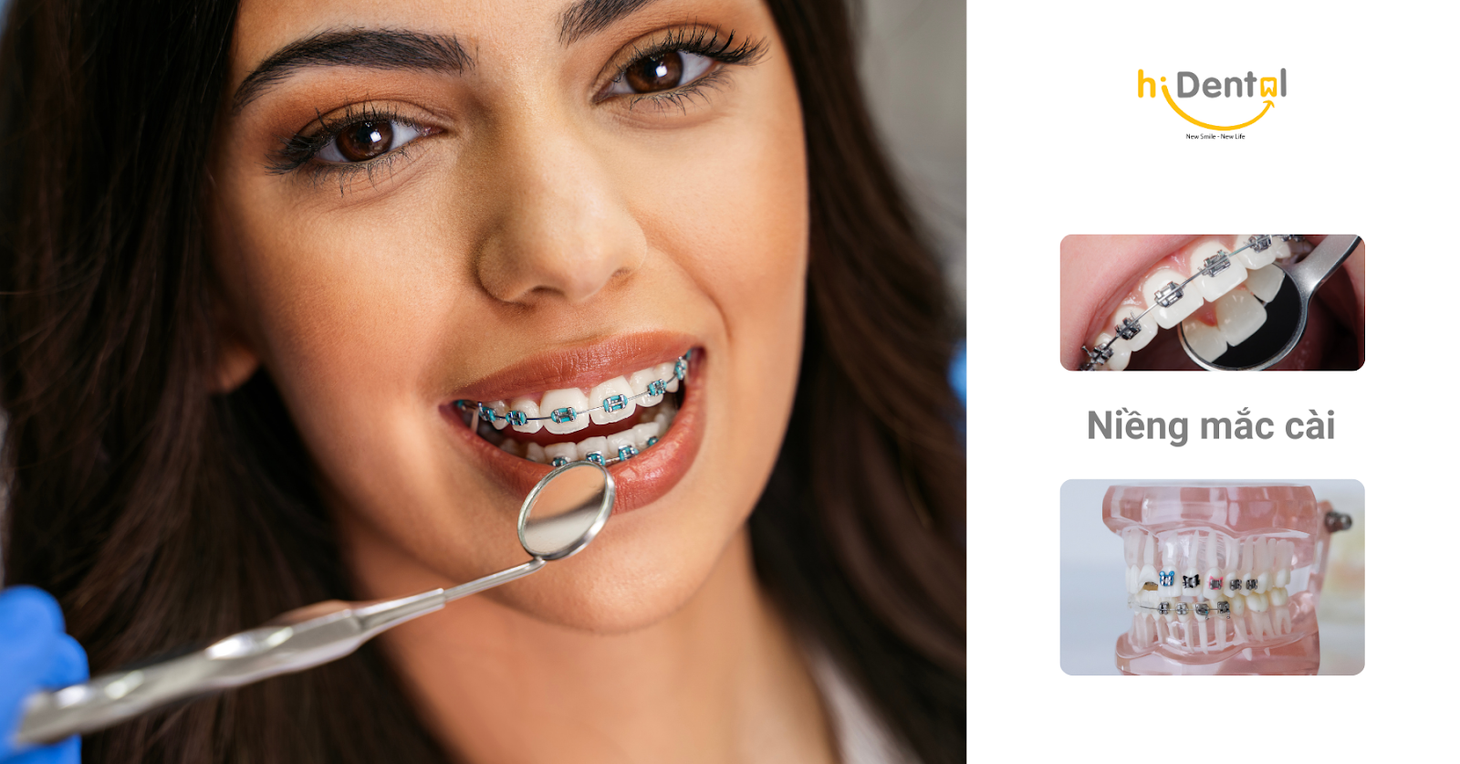 Chi Phí Niềng Răng Mắc Cài