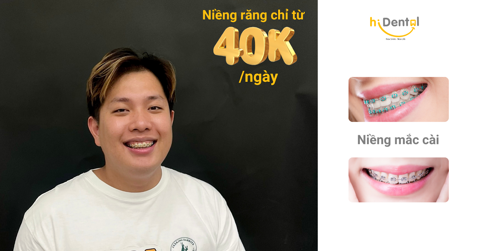 Chi Phí Niềng Răng Mắc Cài