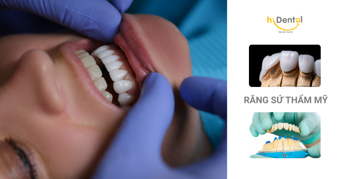 Giá bọc răng sứ là bao nhiêu