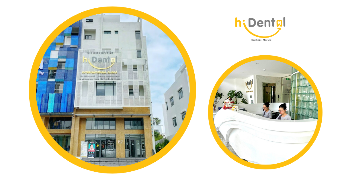  Chi Phí Niềng Răng Bao Nhiêu Tiền