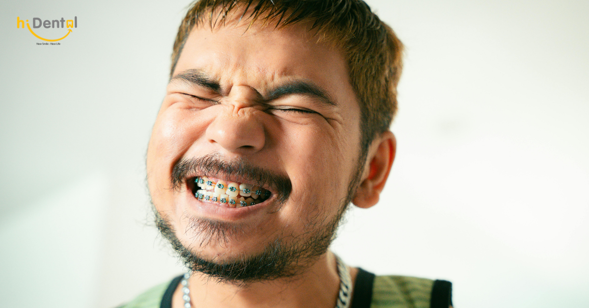 Niềng Răng Có Đau Không