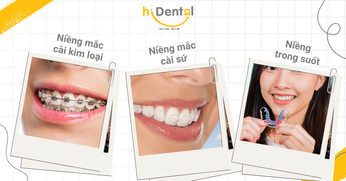 Nha Khoa Niềng Răng