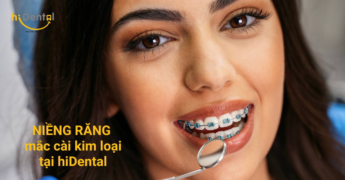 Nha Khoa Niềng Răng