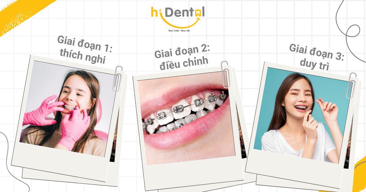 Niềng Răng Có Đau Không