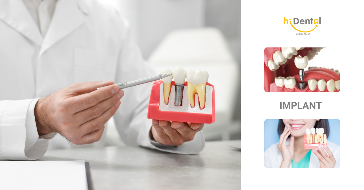 Trồng Răng Implant Uy Tín